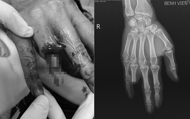 Quảng Ninh: Người đàn ông bị mất ngón tay do trèo hàng rào