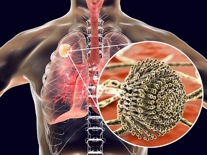 Nâng cao năng lực chẩn đoán và điều trị nấm phổi