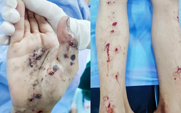 Quảng Nam: 15 mảnh thuỷ tinh găm vào người một học sinh do pháo tự chế phát nổ