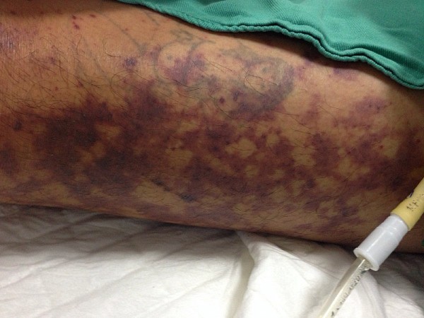 Ghi nhận ca mắc liên cầu lợn đầu tiên trong năm 2024 tại Hà Nội