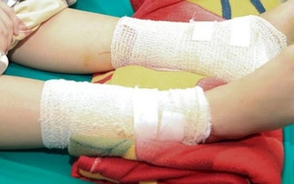 Bé gái 4 tuổi bị lửa cồn đốt bỏng nặng khắp người