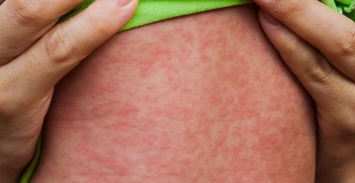 Phòng bệnh sởi cho trẻ em trong mùa xuân