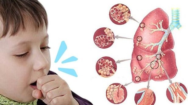 Sở Y tế Hà Nội ra cảnh báo về bệnh ho gà ở trẻ