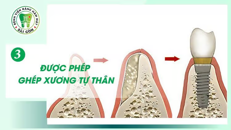 Quy trình làm răng Implant chuẩn y khoa tại Bệnh viện Răng Hàm Mặt Sài Gòn