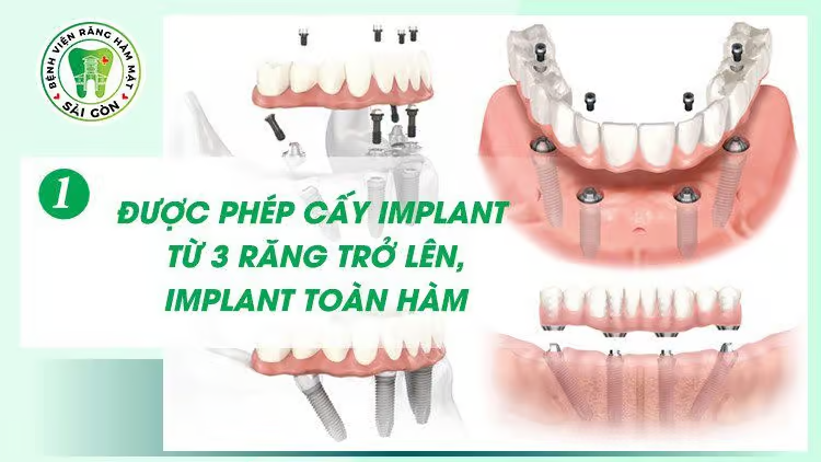 Quy trình làm răng Implant chuẩn y khoa tại Bệnh viện Răng Hàm Mặt Sài Gòn