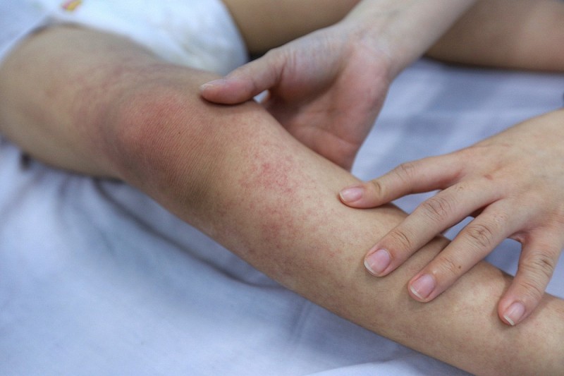 Chủ động phòng chống sốt xuất huyết và hưởng ứng Ngày ASEAN phòng chống sốt xuất huyết