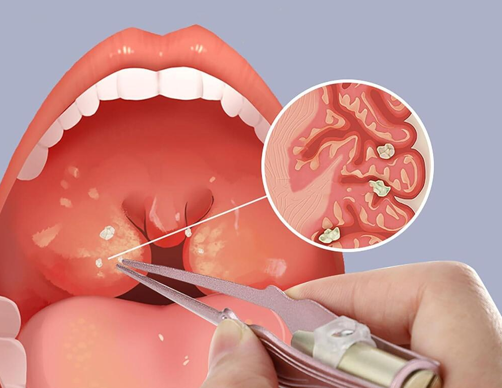 Những cách đơn giản trị sỏi amidan