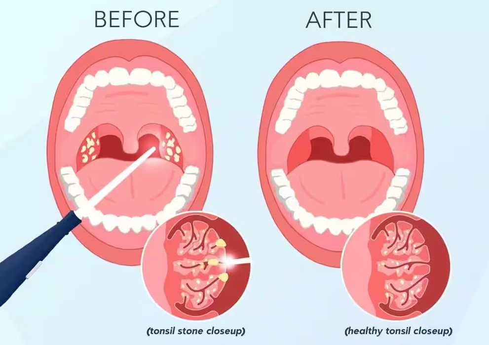 Những cách đơn giản trị sỏi amidan