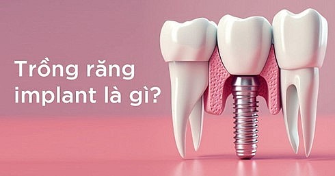 Implant là gì? Phương pháp trồng răng implant có đau không?