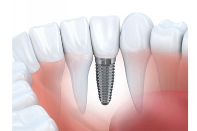 Phương pháp trồng răng implant có đau không?