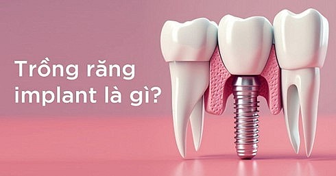 Phương pháp trồng răng implant có đau không?