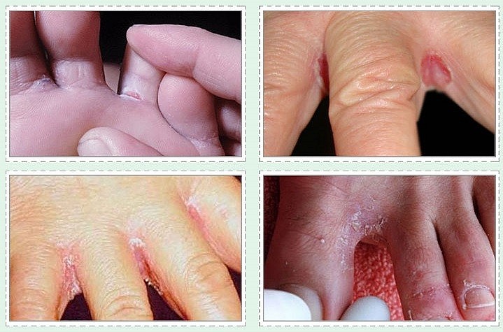 Cẩn trọng các bệnh về da khi mùa mưa đến