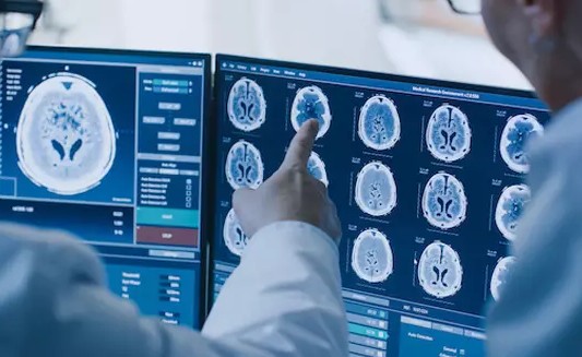 Ứng dụng AI giúp chẩn đoán sớm bệnh Parkinson