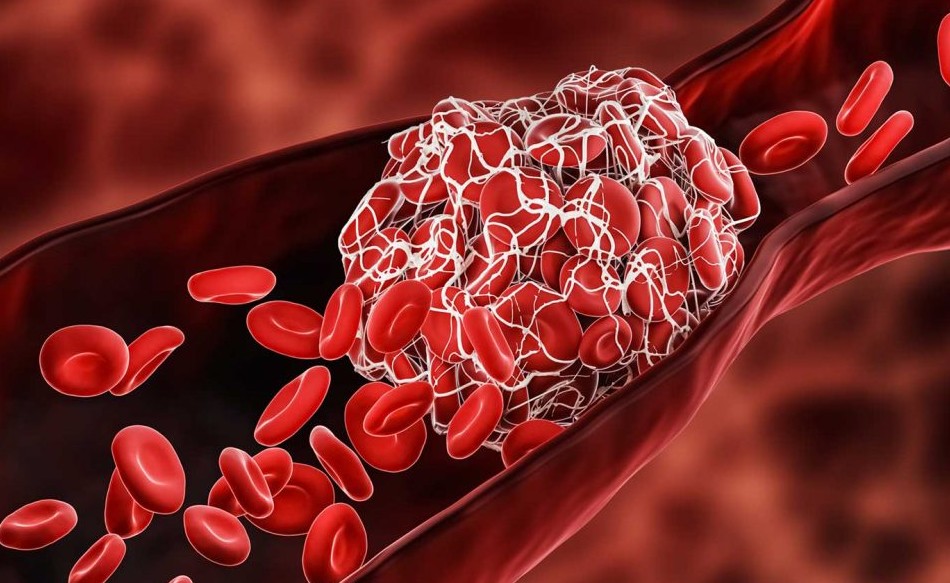 Dấu hiệu phát hiện sớm cục máu đông giúp phòng ngừa đột quỵ