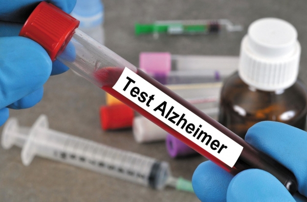 Xét nghiệm máu giúp chẩn đoán bệnh Alzheimer chính xác hơn