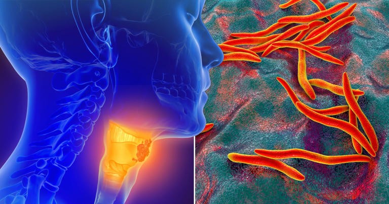 Phát hiện mới: Vi khuẩn khoang miệng có thể tiêu diệt khối u ung thư