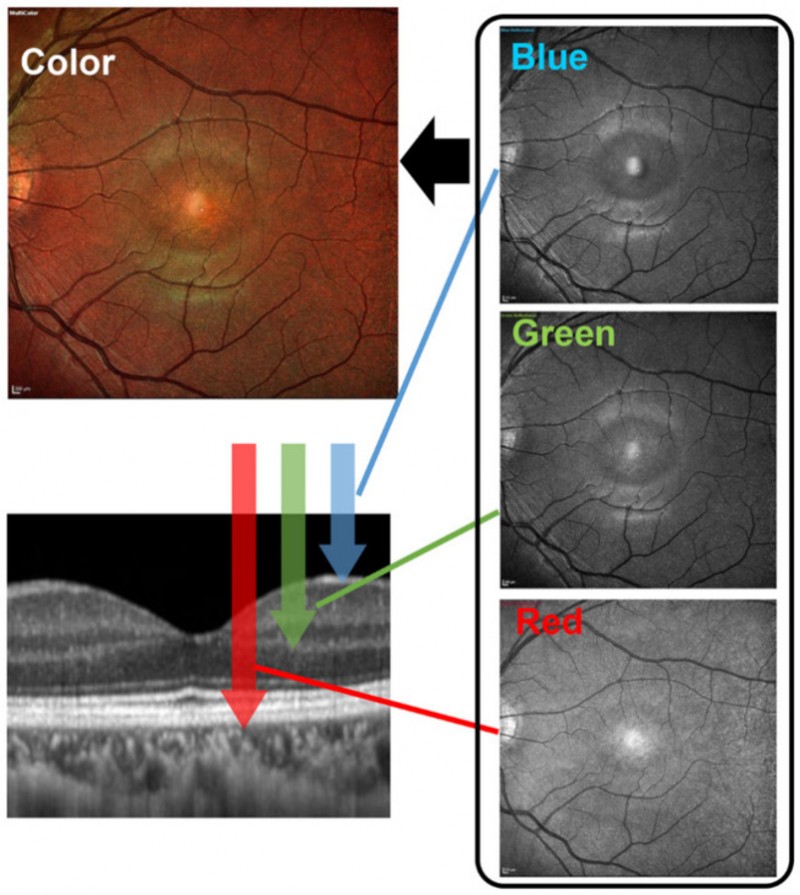 Nghiên cứu so sánh Công nghệ SLO và Chụp ảnh màu đáy mắt thông thường