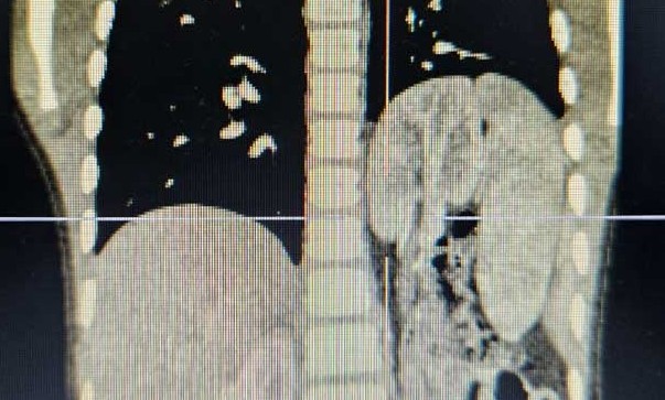 Phẫu thuật thành công cho bé trai 6 tuổi có thận "đi lạc" lên lồng ngực