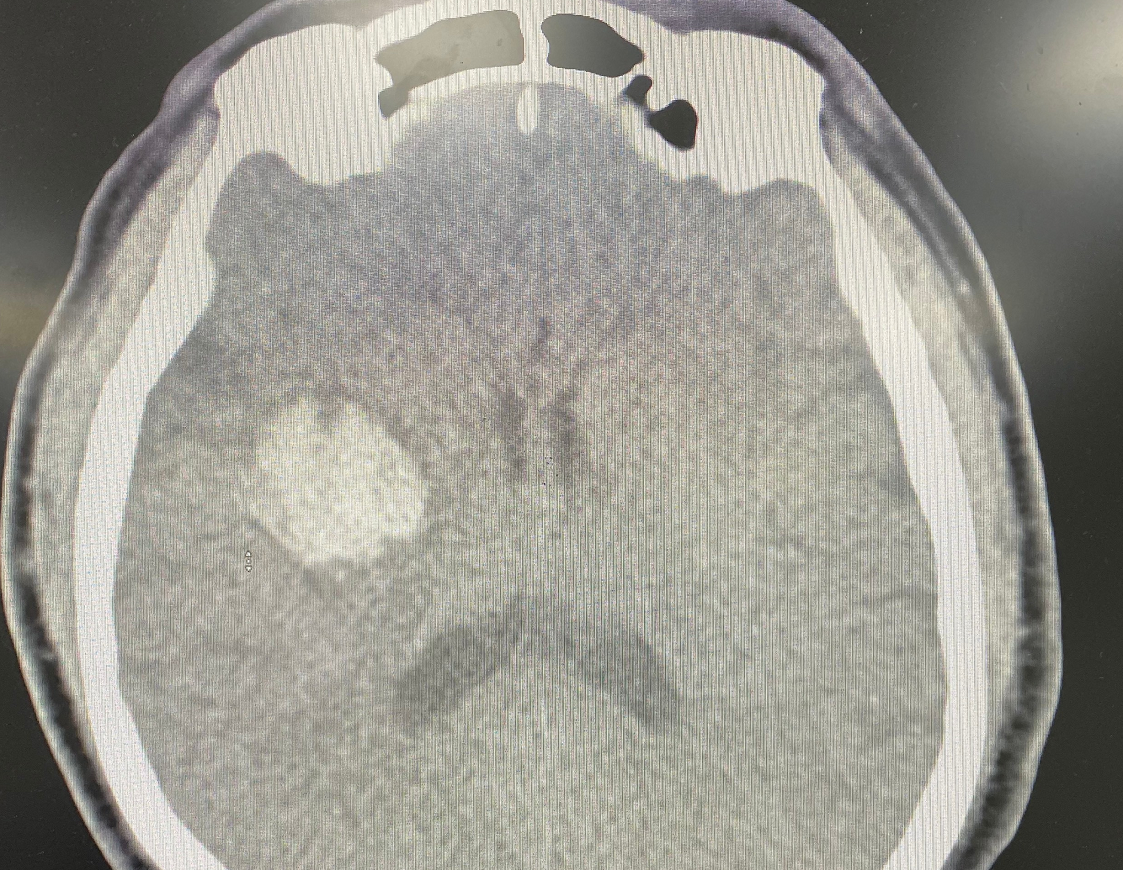 Nguy kịch vì tự ý uống an cung ngưu hoàng hoàn để chữa đột quỵ