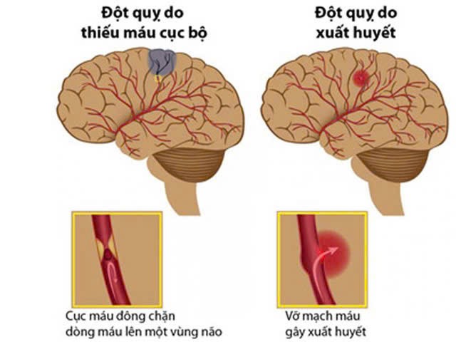 Cảnh báo tình trạng bệnh nhân đột quỵ gia tăng khi thời tiết thay đổi