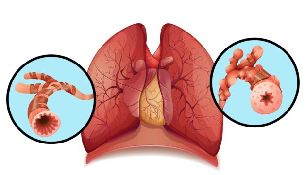 6 câu hỏi thường gặp về bệnh giãn phế quản- Ảnh 1.