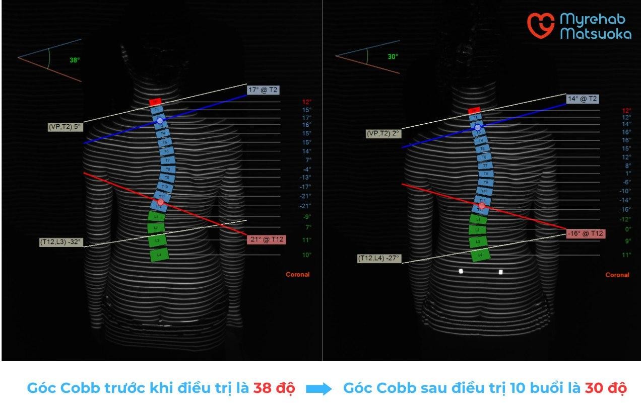 Đưa cột sống cong vẹo trở lại bình thường bằng các bài tập và liệu pháp trị liệu - Chuyện có thật tại MYREHAB MATSUOKA