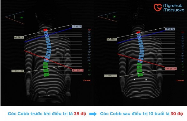 Cảnh báo: Bệnh nhân cong vẹo cột sống đang có xu hướng trẻ hóa