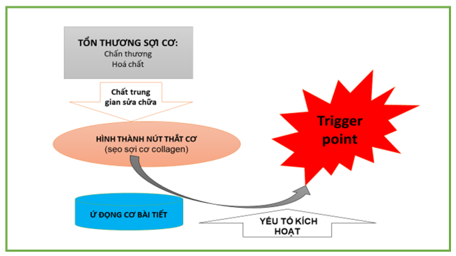 Trigger Point Và A Thị Huyệt theo Y Học Cổ Truyền