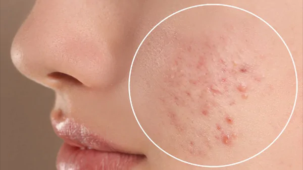 Tỉ lệ rối loạn lo âu xã hội và một số yếu tố liên quan trên bệnh nhân mụn trứng cá