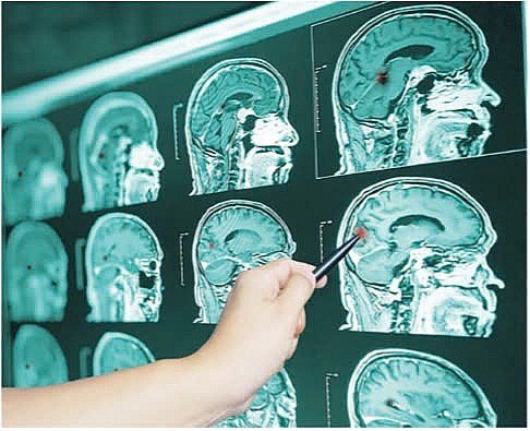 Đánh giá kết quả điều trị bệnh nhân chấn thương sọ não có tăng áp lực nội sọ được mở sọ giảm áp