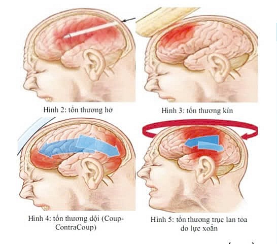 Đánh giá kết quả điều trị bệnh nhân chấn thương sọ não có tăng áp lực nội sọ được mở sọ giảm áp