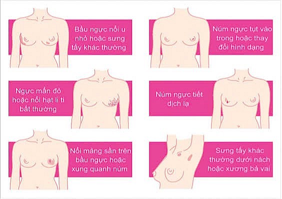 Kiến thức và một số yếu tố liên quan đến phòng và phát hiện sớm ung thư vú