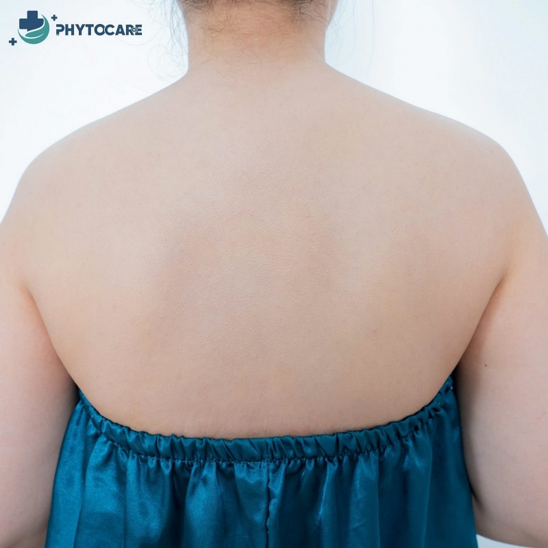 Viêm nang lông sau sinh - Cơn ác mộng của nhiều mẹ bỉm