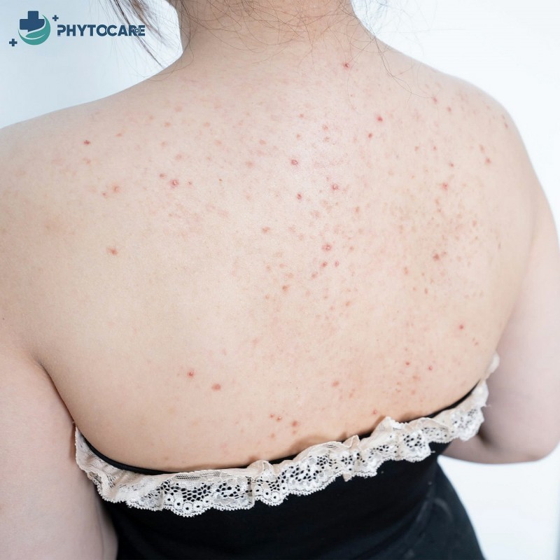 Viêm nang lông sau sinh - Cơn ác mộng của nhiều mẹ bỉm