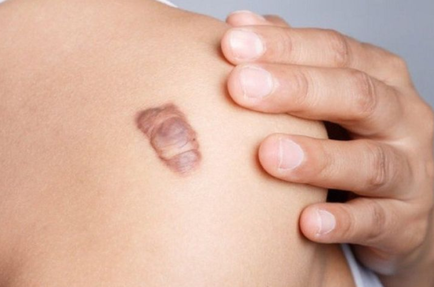 Chấm dứt tình trạng sẹo lâu năm nhờ các biện pháp sau đây! Chấm dứt tình trạng sẹo lâu năm nhờ các biện pháp sau đây!