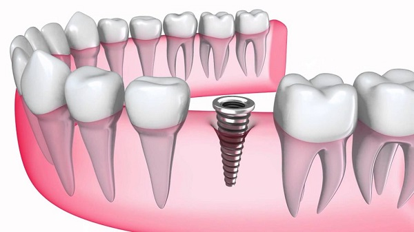 Trồng Implant – Ai phù hợp và những điều quan trọng cần biết! Trồng Implant – Ai phù hợp và những điều quan trọng cần biết!