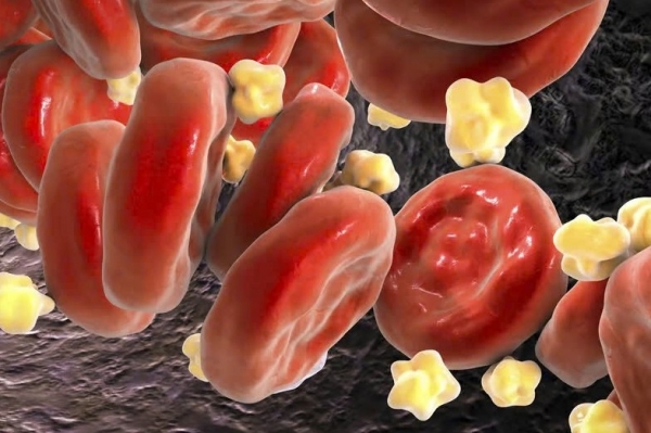 Phương pháp kết hợp thuốc uống giúp giảm gần 50% cholesterol xấu trong thử nghiệm lâm sàng