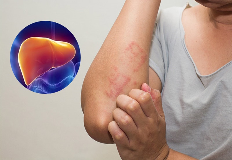 Những dấu hiệu cảnh báo bệnh gan bạn không nên bỏ qua