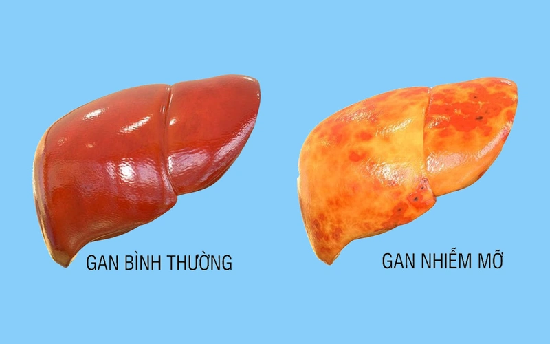 Ai dễ mắc bệnh gan nhiễm mỡ không do rượu?