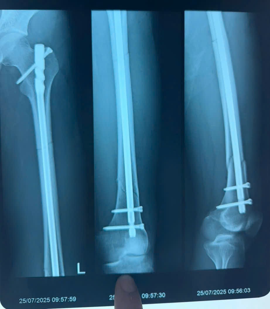 Gia Lai: Ca cấp cứu ngoại viện thần tốc giành lại sự sống cho bệnh nhân tai nạn giao thông Gia Lai: Ca cấp cứu ngoại viện thần tốc giành lại sự sống cho bệnh nhân tai nạn giao thông