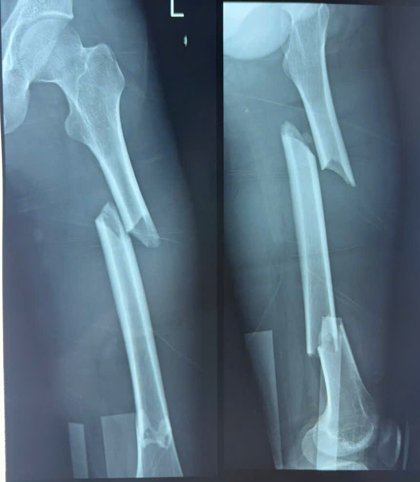 Gia Lai: Ca cấp cứu ngoại viện thần tốc giành lại sự sống cho bệnh nhân tai nạn giao thông Gia Lai: Ca cấp cứu ngoại viện thần tốc giành lại sự sống cho bệnh nhân tai nạn giao thông