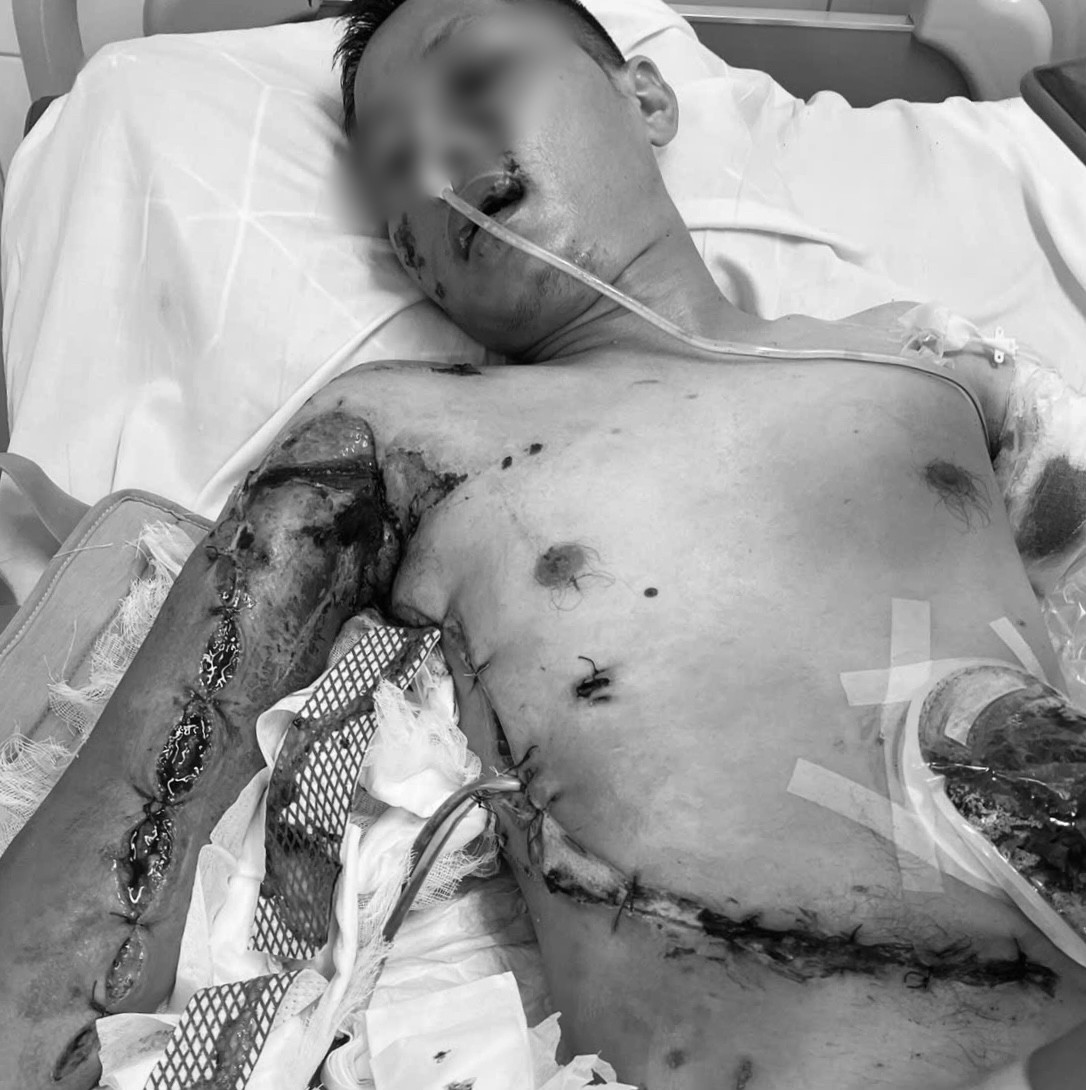 Giành giật sự sống từ lưỡi hái tử thần: Hành trình kỳ diệu của người đàn ông 35 tuổi và trái tim các thầy thuốc Bệnh viện Việt Đức