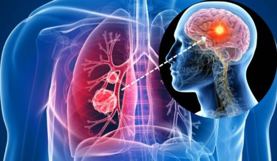 Cảnh báo triệu chứng ung thư phổi di căn não: Điều cần biết Cảnh báo triệu chứng ung thư phổi di căn não: Điều cần biết