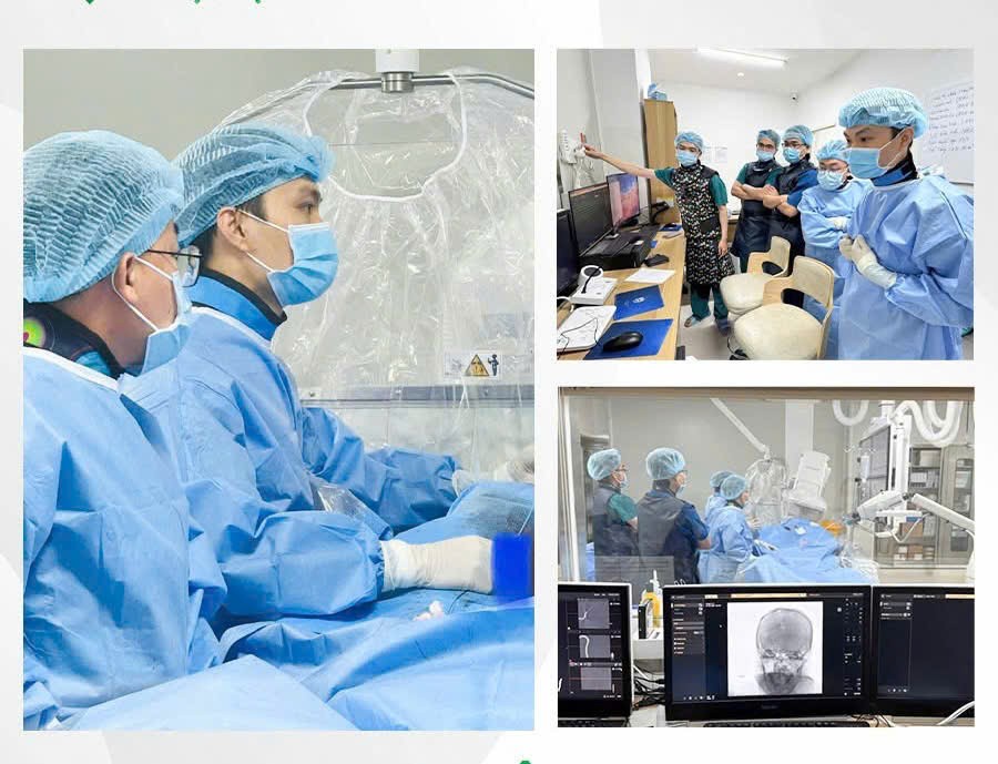 Điều trị thành công ca đột quỵ não nghi do vỡ dị dạng mạch máu não tái phát