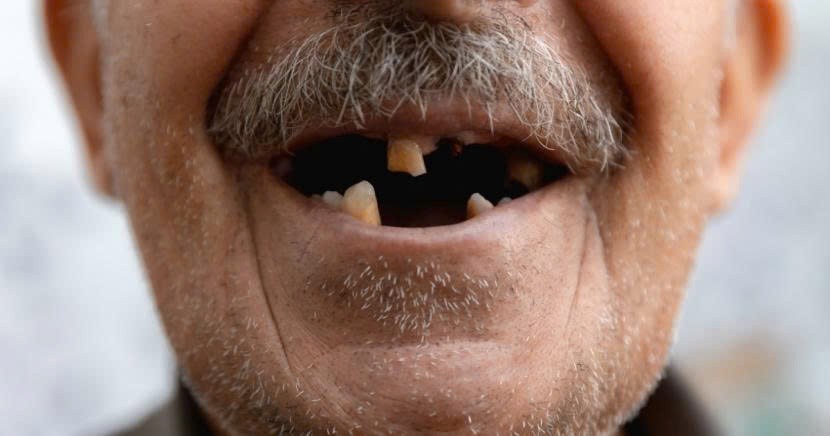 Chăm sóc răng miệng tuổi 50+: Vì sao trồng răng sớm lại tốt hơn để mất răng lâu dài?