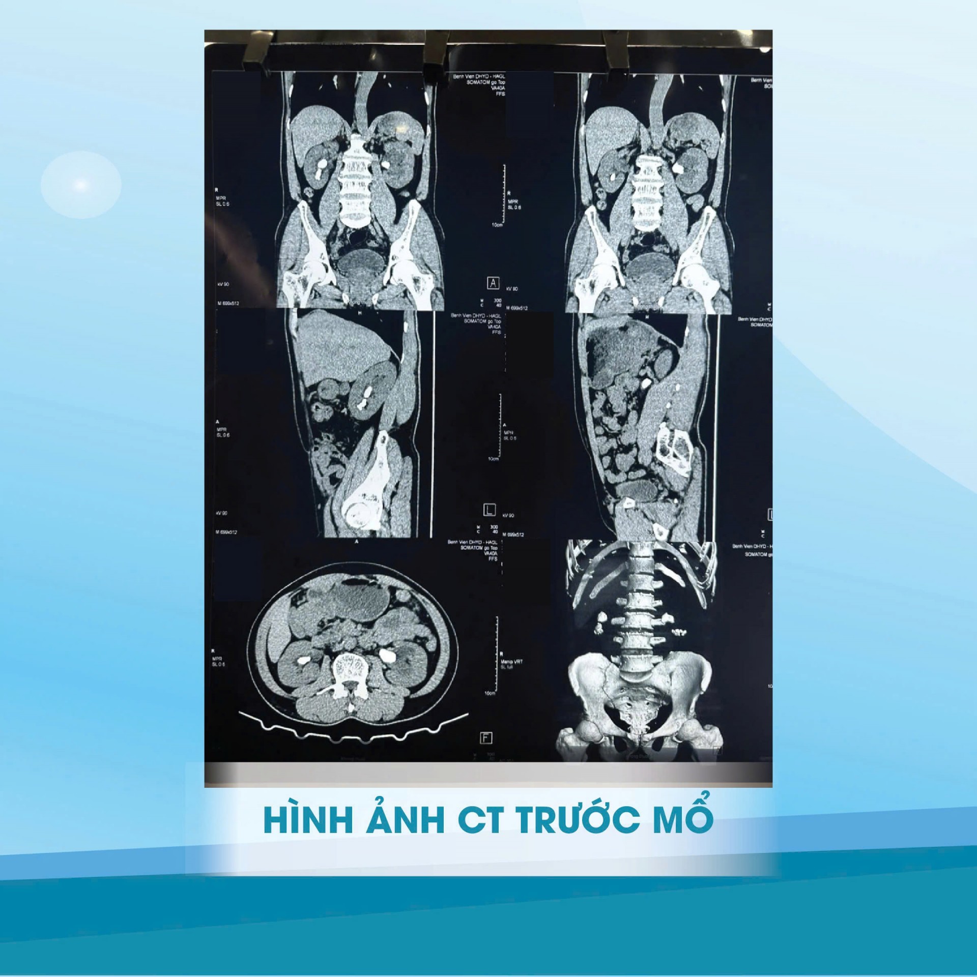 Bệnh viện Đại học Y Dược – Hoàng Anh Gia Lai áp dụng kỹ thuật tiên tiến ít xâm lấn cho bệnh nhân sỏi thận