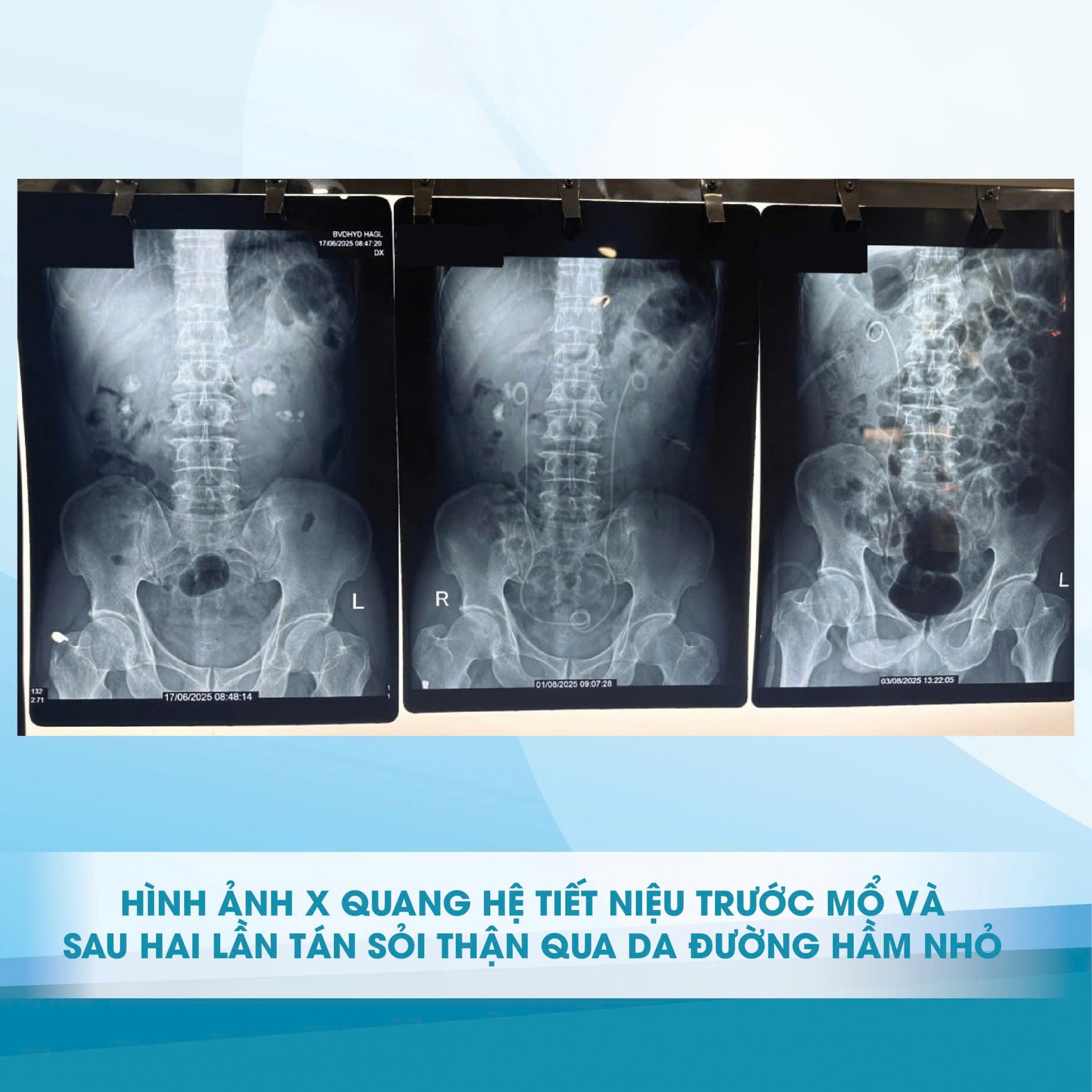 Bệnh viện Đại học Y Dược – Hoàng Anh Gia Lai áp dụng kỹ thuật tiên tiến ít xâm lấn cho bệnh nhân sỏi thận