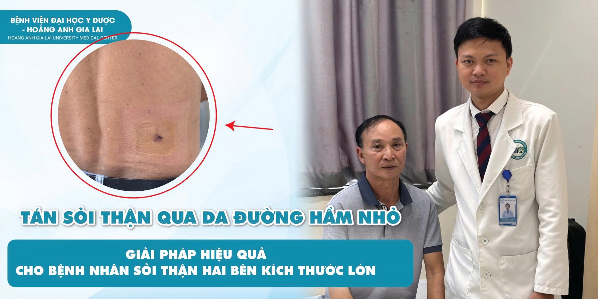 Bệnh viện Đại học Y Dược – Hoàng Anh Gia Lai áp dụng kỹ thuật tiên tiến ít xâm lấn cho bệnh nhân sỏi thận