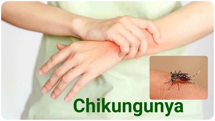 Bệnh Chikungunya: Nguy cơ tiềm ẩn và cách phòng ngừa hiệu quả