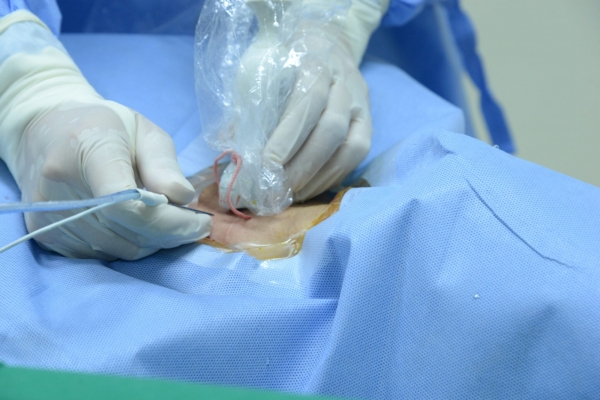 Đột phá mới trong điều trị hạch cổ tái phát sau ung thư tuyến giáp tại Việt Nam